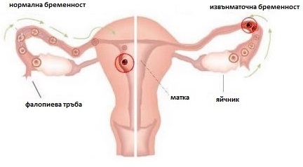 Извънматочната бременност